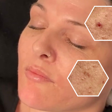 microneedling for skin tightening scar and texture reduction pore reduction wound healing brightening and smoothing